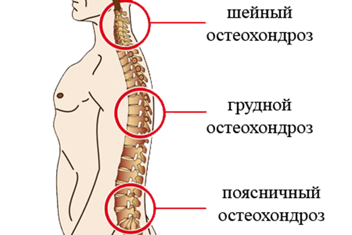 Бывает грудной остеохондроз